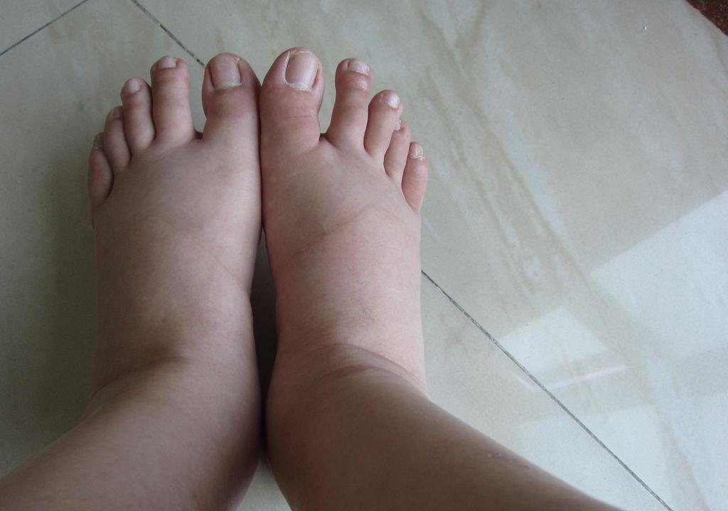 Chân như chuông cảnh báo ung thư phổi: Thấy 3 điểm bất thường này, phải đi chụp CT càng sớm càng tốt! - Ảnh 3.