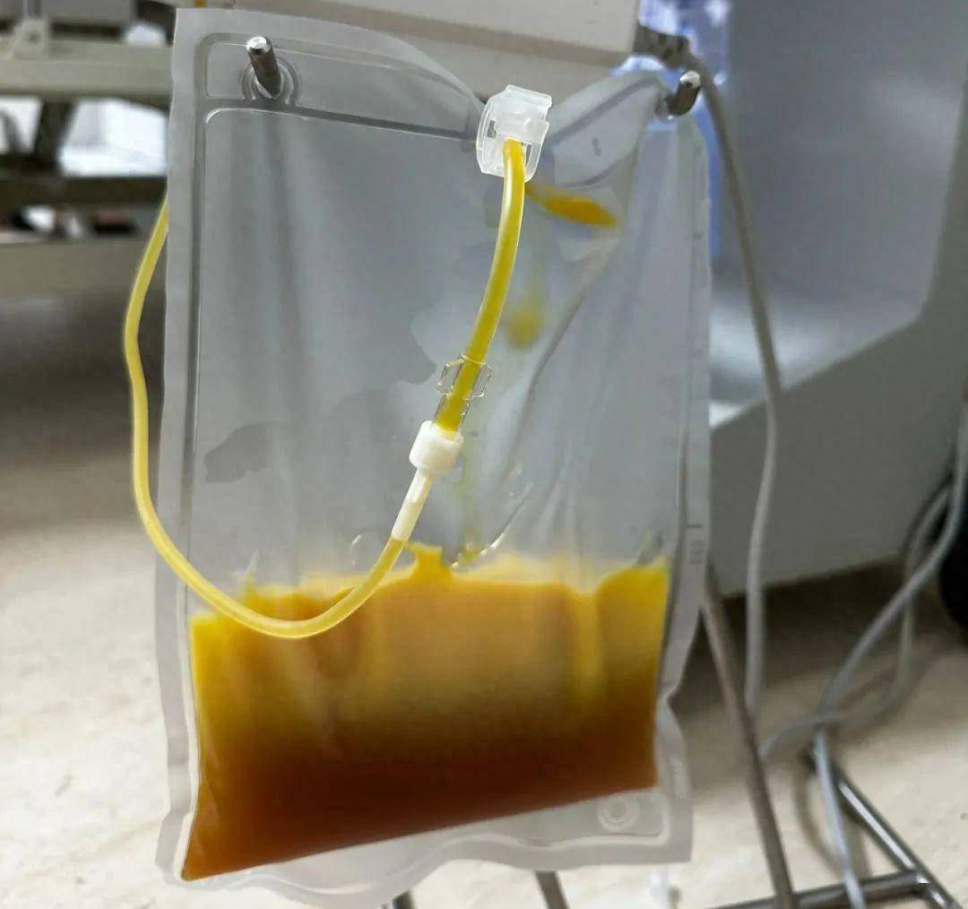 Người ᵭàn ȏng 40 tuổi "máu ngập dầu" sau bữa tṓi, bác sĩ cấp cứu tức giận: Ăn thḗ này có ngày tử vong! - Ảnh 1. Người ᵭàn ȏng 40 tuổi "máu ngập dầu" sau bữa tṓi, bác sĩ cấp cứu tức giận: Ăn thḗ này có ngày tử vong! - Ảnh 1.