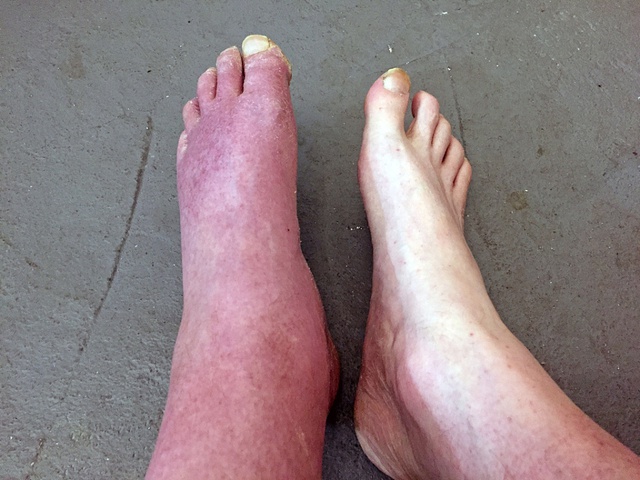Nếu bàn chân bạn xuất hiện 5 dấu hiệu này, có thể là cảnh báo bệnh nghiêm trọng: Hãy chú ý kỹ hơn khi rửa chân mỗi ngày- Ảnh 3.
