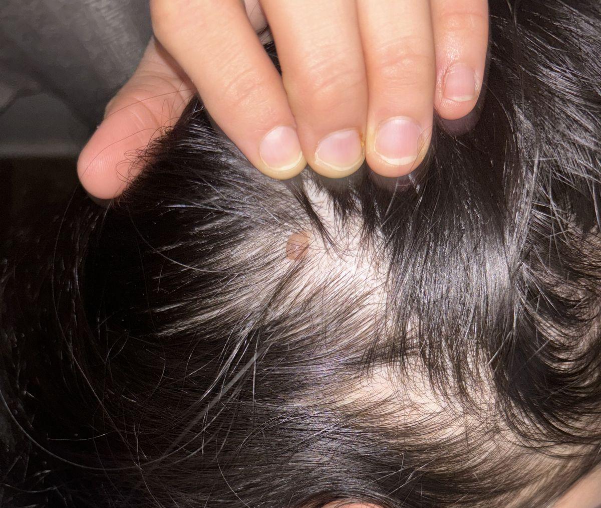 Chải đầu mà thấy 3 bất thường này phải cảnh giác với ung thư: Tiếc là ít người để tâm! - Ảnh 2.