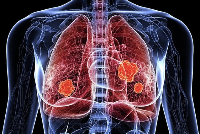 Không ho, không khó thở, người đàn ông 48 tuổi bị sưng chân đi bất ngờ khám phát hiện ung thư phổi giai đoạn 3: Bác sĩ cảnh báo nóng! - Ảnh 1.