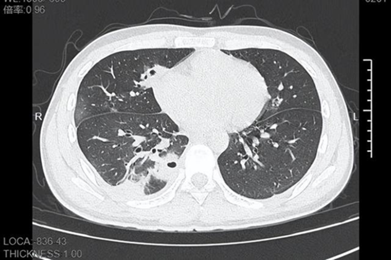 Chàng trai 20 tuổi bị thủng hơn 10 lỗ ở phổi sau khi nặn mụn!- Ảnh 2. Chàng trai 20 tuổi bị thủng hơn 10 lỗ ở phổi sau khi nặn mụn!- Ảnh 2.