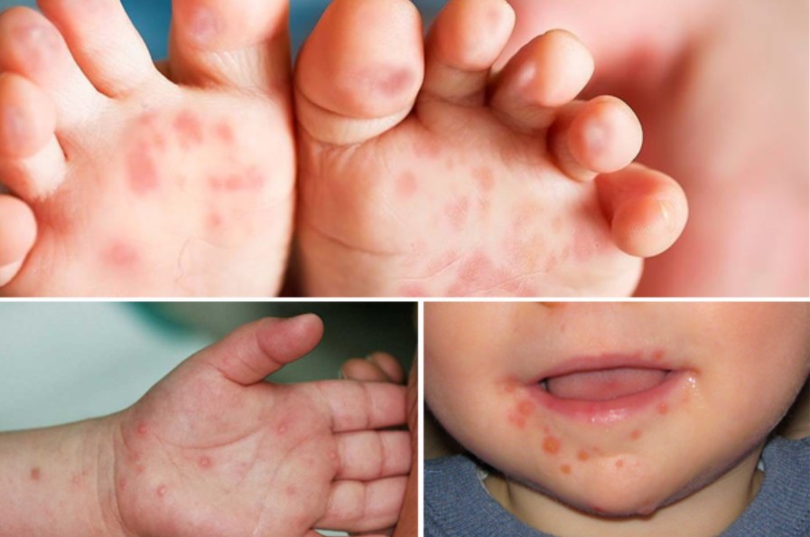 Lo sợ dịch chồng dịch: Cúm A chưa tới đỉnh dịch, Hà Nội và TP.HCM lại ghi nhận hàng nghìn ca nhiễm bệnh trong 1 tuần- Ảnh 2. Lo sợ dịch chồng dịch: Cúm A chưa tới đỉnh dịch, Hà Nội và TP.HCM lại ghi nhận hàng nghìn ca nhiễm bệnh trong 1 tuần- Ảnh 2.