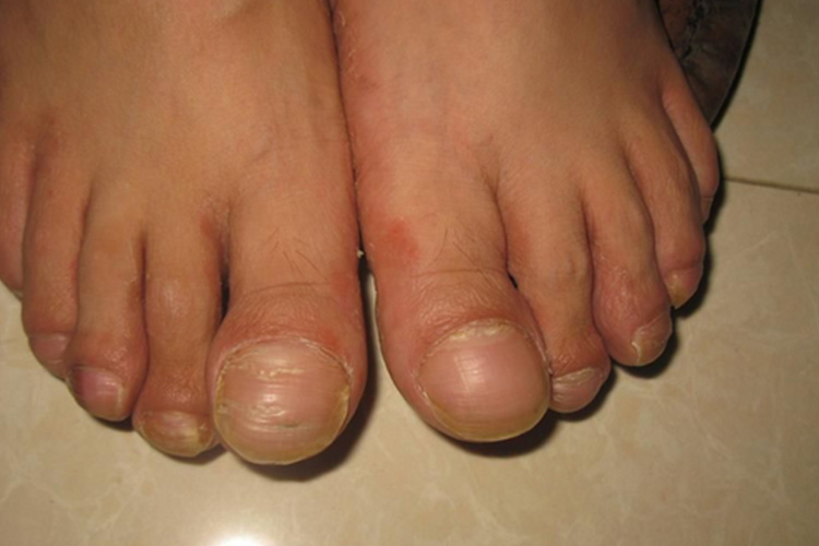 4 bất thường ở chân là dấu hiệu ung thư phổi dù nói ra có nhiều người CHẲNG CHỊU TIN! - Ảnh 2.