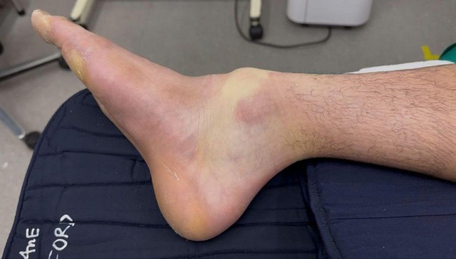 Đánh pickleball suốt 4 tiếng, nam thanh niên 28 tuổi gãy xương chân- Ảnh 1.