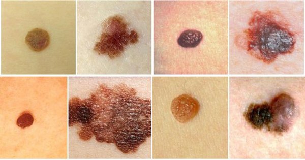 Tưởng nốt ruồi lộc trên mắt hoá ra mắc UNG THƯ DA, bác sĩ sửng sốt: Sai lầm chết người khi coi thường một ‘dấu chấm nhỏ’ Tưởng nốt ruồi lộc trên mắt hoá ra mắc UNG THƯ DA, bác sĩ sửng sốt: Sai lầm chết người khi coi thường một ‘dấu chấm nhỏ’