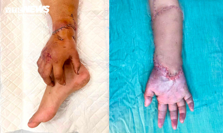 Bàn tay đứt lìa của mẹ bầu được nối lại Sau 2 tháng ' nuôi ' ở chân - Ảnh 1. Bàn tay đứt lìa của mẹ bầu được nối lại Sau 2 tháng ' nuôi ' ở chân - Ảnh 1.