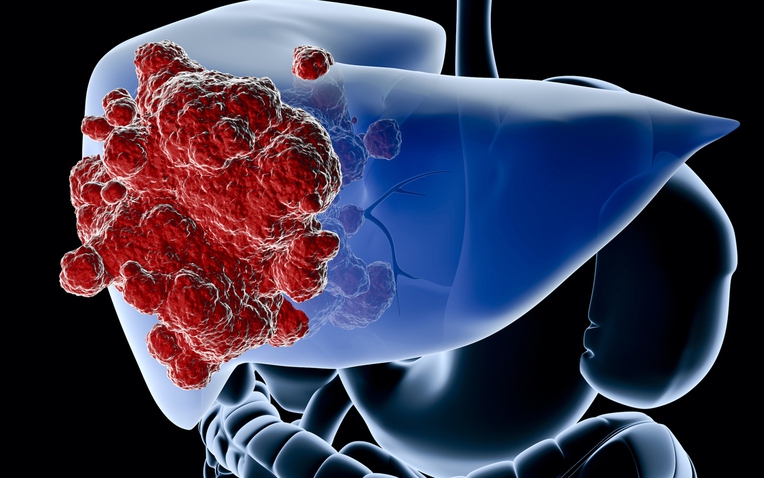 Bất ngờ phát hiện ung thư gan giai đoạn muộn từ 3 dấu hiệu lạ ở bụng - Ảnh 1.