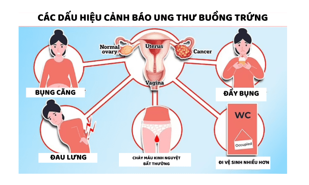 Cuộc chiến sống còn của người phụ nữ 50 tuổi sau khi phẫu thuật loại bỏ 7 cơ quan vì ung thư buồng trứng giai đoạn 4- Ảnh 2. Cuộc chiến sống còn của người phụ nữ 50 tuổi sau khi phẫu thuật loại bỏ 7 cơ quan vì ung thư buồng trứng giai đoạn 4- Ảnh 2.