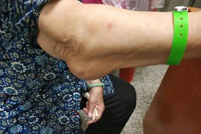 Bất kể nam hay nữ, nếu gặp phải 4 triệu chứng này ở cánh tay, rất có thể bạn bị ung thư: Dấu hiệu thứ 3 bị bỏ qua nhiều nhất- Ảnh 3. Bất kể nam hay nữ, nếu gặp phải 4 triệu chứng này ở cánh tay, rất có thể bạn bị ung thư: Dấu hiệu thứ 3 bị bỏ qua nhiều nhất- Ảnh 3.