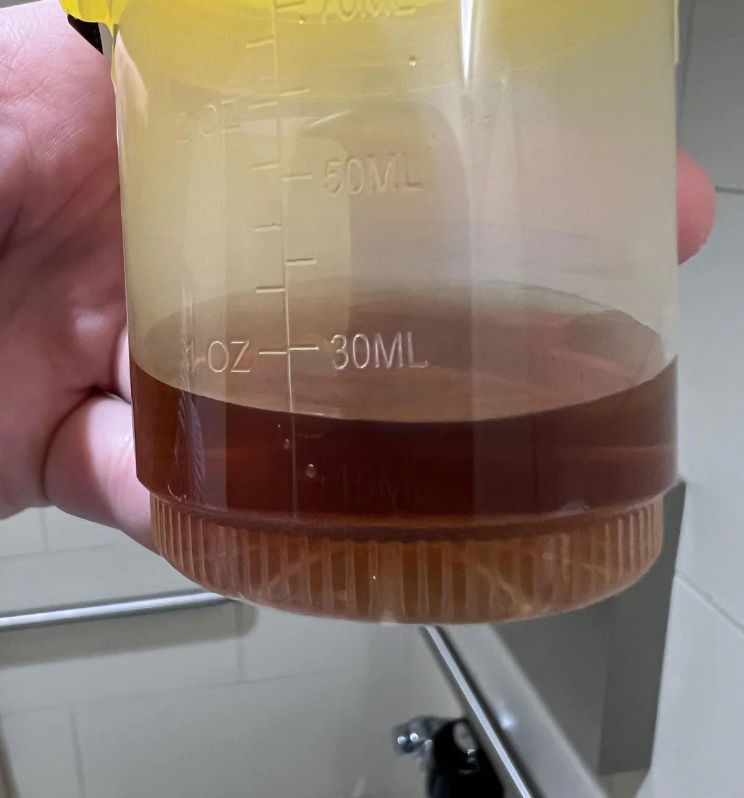 Cảnh báo: Bất kể nam hay nữ, nếu 3 thứ này trên người ngày càng “đen” chứng tỏ thận chất đầy độc tố - Ảnh 3.