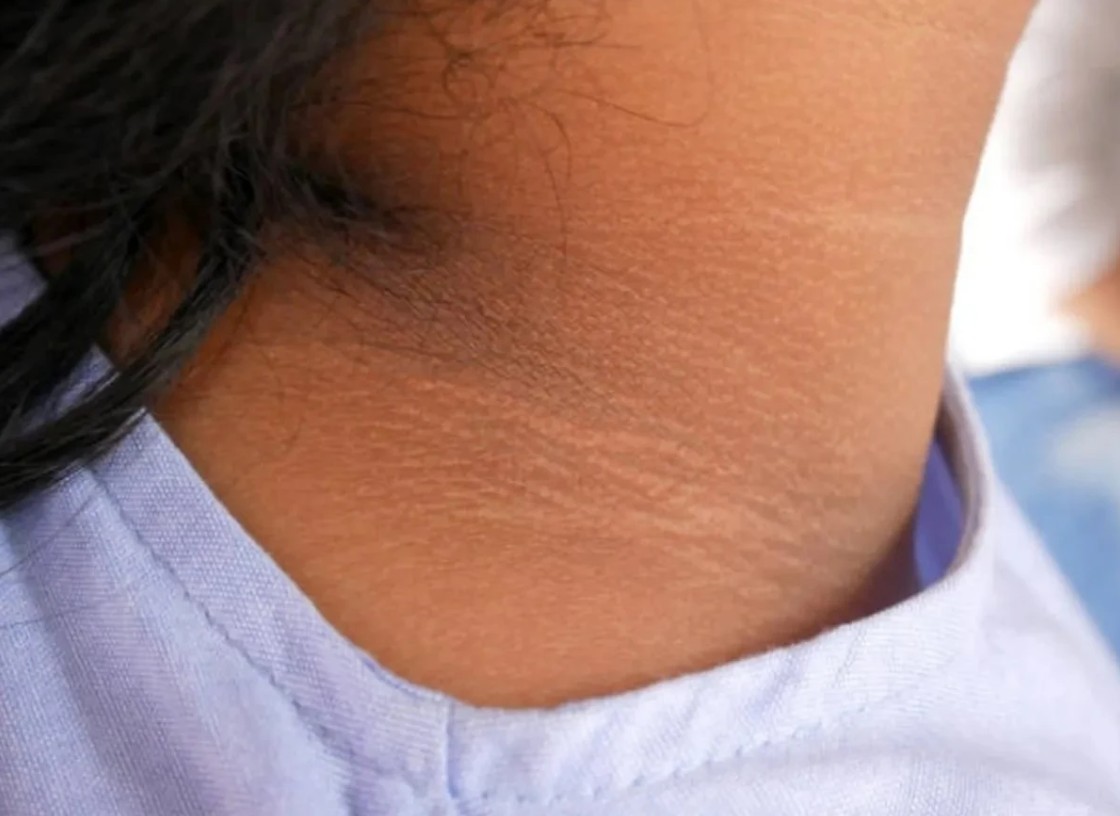 8 Dấu hiệu bệnh gan biểu hiện trên mặt không thể bỏ qua - Ảnh 3. 8 Dấu hiệu bệnh gan biểu hiện trên mặt không thể bỏ qua - Ảnh 3.