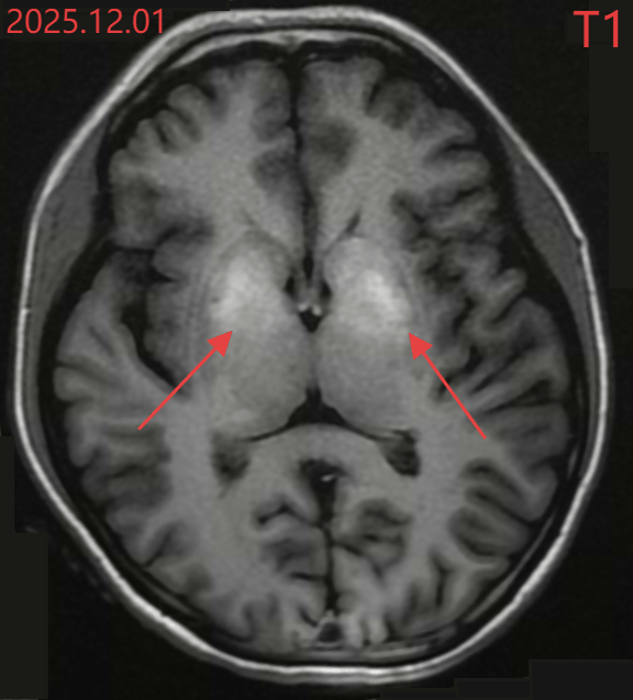 Cô gái 20 tuổi nhảy múa không ngừng do bệnh lý tiểu đường hiếm gặp ở Việt Nam - Ảnh 1. Cô gái 20 tuổi nhảy múa không ngừng do bệnh lý tiểu đường hiếm gặp ở Việt Nam - Ảnh 1.