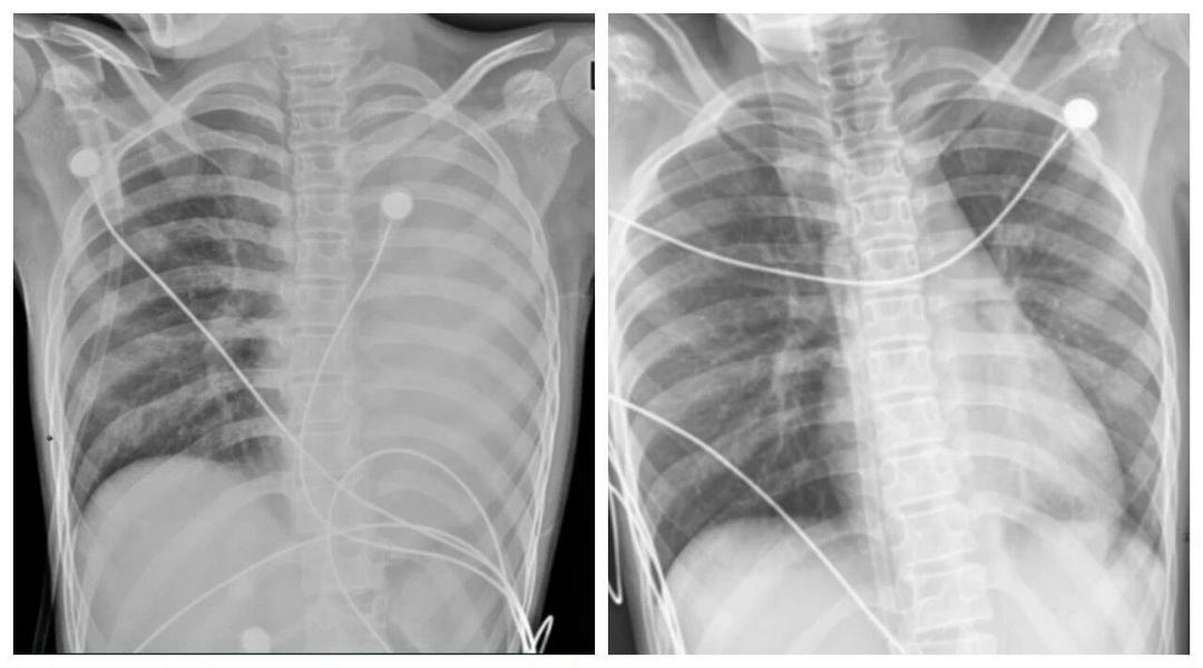 Bé trai 12 tuổi mắc cúm H3N2 phổi trắng xóa chỉ sau 24 giờ cần cảnh giác - Ảnh 2. Bé trai 12 tuổi mắc cúm H3N2 phổi trắng xóa chỉ sau 24 giờ cần cảnh giác - Ảnh 2.