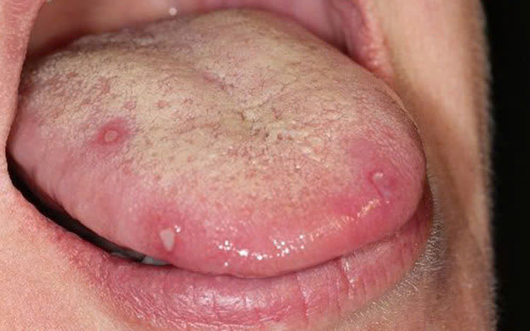 5 Dấu hiệu sức khỏe từ lưỡi bạn không nên bỏ qua để bảo vệ cơ thể - Ảnh 1. 5 Dấu hiệu sức khỏe từ lưỡi bạn không nên bỏ qua để bảo vệ cơ thể - Ảnh 1.