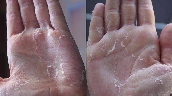 Khổ cả mùa đông vì da tay da chân bong tróc: Thói quen nhiều người vẫn làm mà không nhận ra đang tự làm đau mình- Ảnh 3. Khổ cả mùa đông vì da tay da chân bong tróc: Thói quen nhiều người vẫn làm mà không nhận ra đang tự làm đau mình- Ảnh 3.