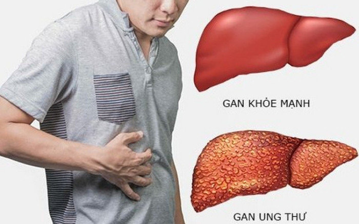 Ung thư gan có chữa khỏi không? phương pháp và cách phòng ngừa hiệu quả - Ảnh 1. Ung thư gan có chữa khỏi không? phương pháp và cách phòng ngừa hiệu quả - Ảnh 1.