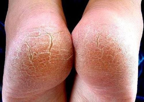 5 Dấu hiệu sức khỏe ở bàn chân bạn không nên bỏ qua ngay hôm nay - Ảnh 3. 5 Dấu hiệu sức khỏe ở bàn chân bạn không nên bỏ qua ngay hôm nay - Ảnh 3.