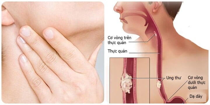 Những dấu hiệu ung thư thực quản giai đoạn đầu- Ảnh 1.