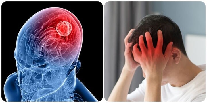 Dấu hiệu u não ác tính không nên bỏ qua- Ảnh 1. Dấu hiệu u não ác tính không nên bỏ qua- Ảnh 1.