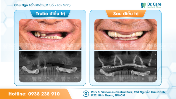 Làm răng tuổi 58, có nên đánh đổi sức khỏe chọn giá rẻ?- Ảnh 2. Làm răng tuổi 58, có nên đánh đổi sức khỏe chọn giá rẻ?- Ảnh 2.