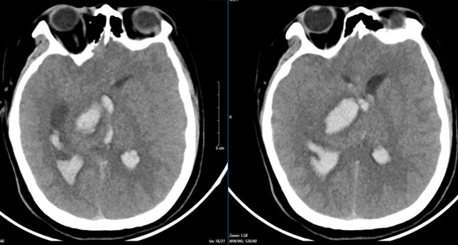 Căn bệnh 'tử thần' đưa đến viện thường đã muộn, dấu hiệu cảnh báo chỉ đau đầu, tê bì chân tay- Ảnh 2.