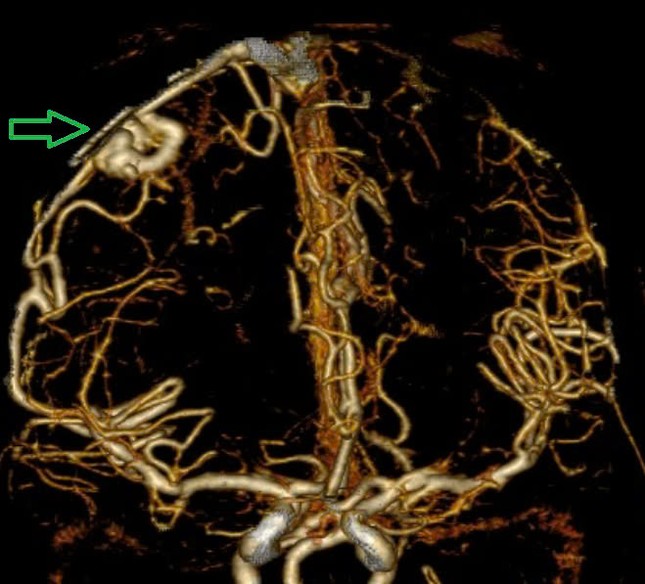 Căn bệnh 'tử thần' đưa đến viện thường đã muộn, dấu hiệu cảnh báo chỉ đau đầu, tê bì chân tay- Ảnh 3.