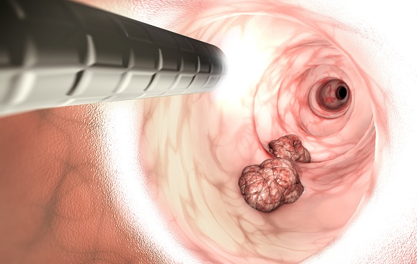 Ung thư giai đoạn sớm thường “rất ngoan”, bác sĩ Bạch Mai chỉ cách phát hiện và ngăn chặn kịp thời- Ảnh 1.