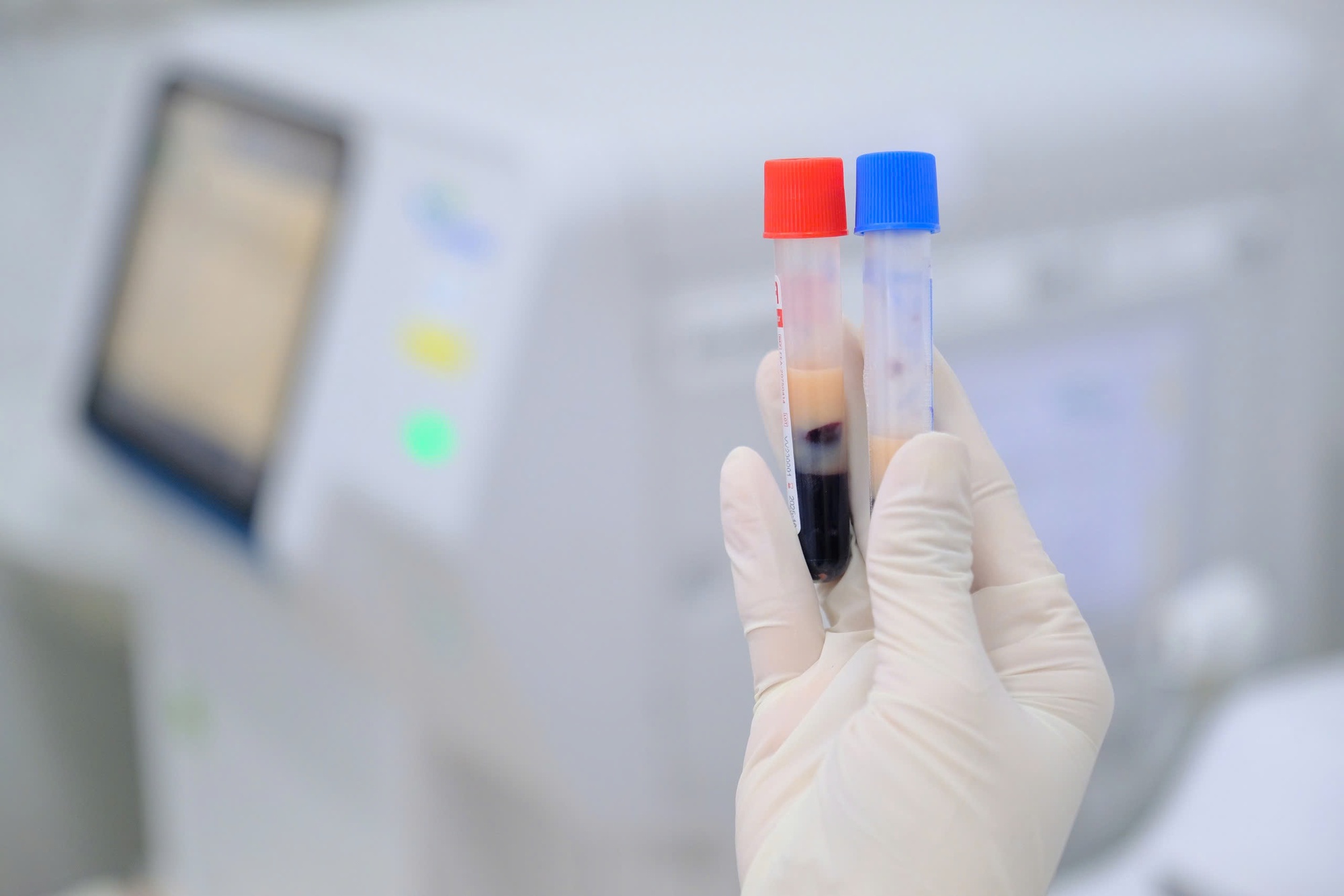 Chàng trai 29 tuổi đi khám, phát hiện máu đục như sữa, mỡ máu cao gấp 15 lần: Bác sĩ báo động người trẻ- Ảnh 1.