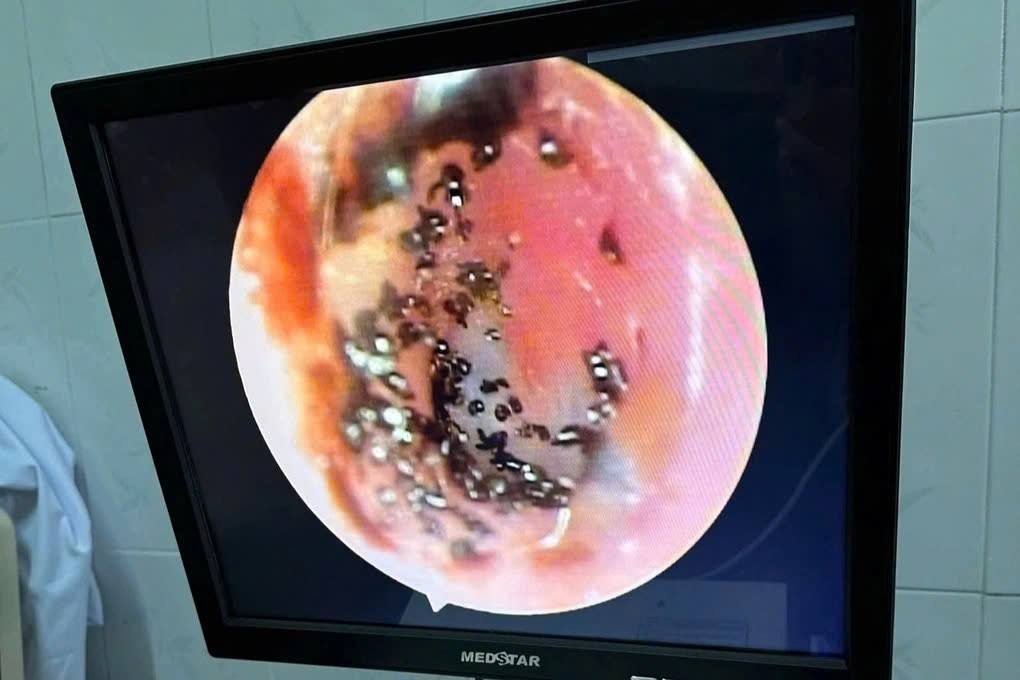 Bé trai bị ve chó làm tổ trong ống tai: Cảnh báo nguy cơ từ thú cưng- Ảnh 1.