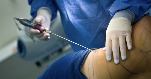 Tạm ngưng hút mỡ bụng tại Bệnh viện Đa khoa Gia Định- Ảnh 1. Tạm ngưng hút mỡ bụng tại Bệnh viện Đa khoa Gia Định- Ảnh 1.