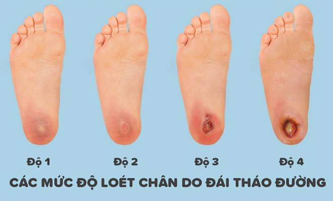 Bác sĩ thức trắng đêm để cứu bệnh nhân khỏi lằn ranh sinh - tử: Xin đừng chủ quan ngay cả những vết thương nhỏ tưởng chừng vô hại- Ảnh 2. Bác sĩ thức trắng đêm để cứu bệnh nhân khỏi lằn ranh sinh - tử: Xin đừng chủ quan ngay cả những vết thương nhỏ tưởng chừng vô hại- Ảnh 2.