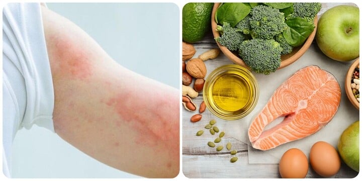 Dấu hiệu thiếu Omega-3 bạn không nên chủ quan- Ảnh 1. Dấu hiệu thiếu Omega-3 bạn không nên chủ quan- Ảnh 1.