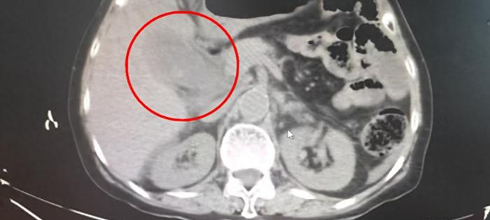 Sốc khi lấy ra 95 viên sỏi từ cơ thể người phụ nữ 40 tuổi, bác sĩ nhắc 