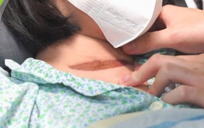 Bé gái ngừng tim, phù phổi vì bị cửa cuốn kẹp cổ- Ảnh 1. Bé gái ngừng tim, phù phổi vì bị cửa cuốn kẹp cổ- Ảnh 1.