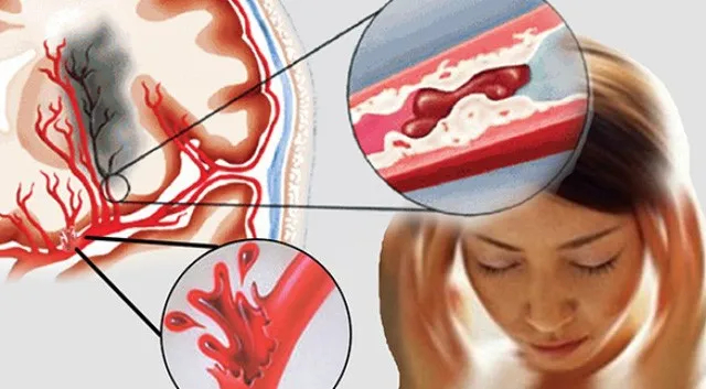 Những người bị nhồi máu não thường có điểm chung này: Liệu bạn có đang sống trong nguy cơ tắc mạch máu não?- Ảnh 3. Những người bị nhồi máu não thường có điểm chung này: Liệu bạn có đang sống trong nguy cơ tắc mạch máu não?- Ảnh 3.