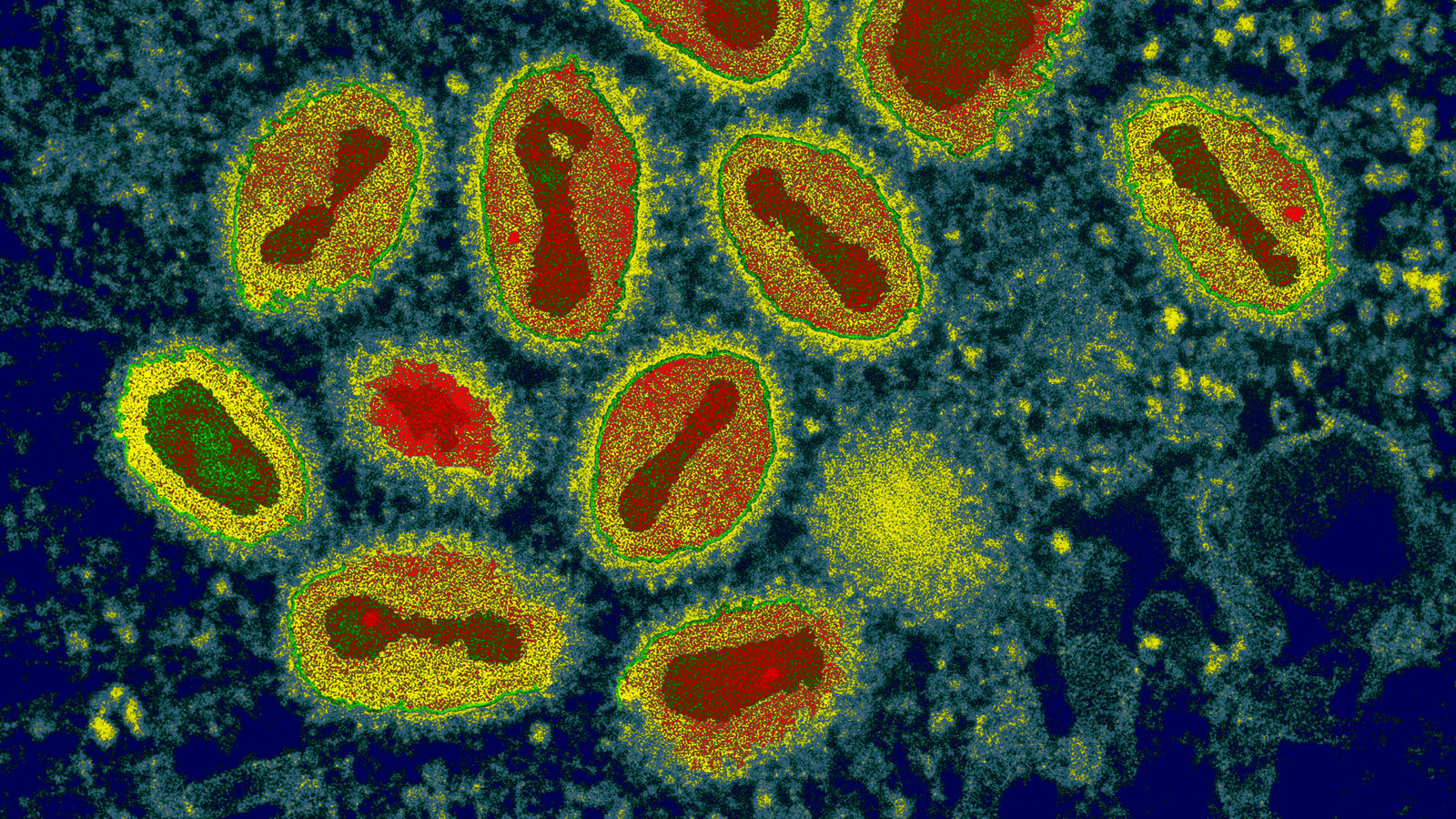 Căn bệnh này từng giết hàng trăm triệu người: Vì sao nhân loại bỗng dưng xóa sổ được chỉ sau vài thập kỷ?- Ảnh 5.