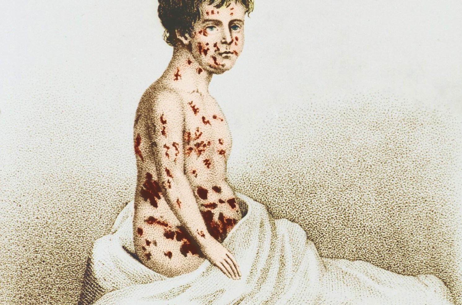 Căn bệnh này từng giết hàng trăm triệu người: Vì sao nhân loại bỗng dưng xóa sổ được chỉ sau vài thập kỷ?- Ảnh 3.