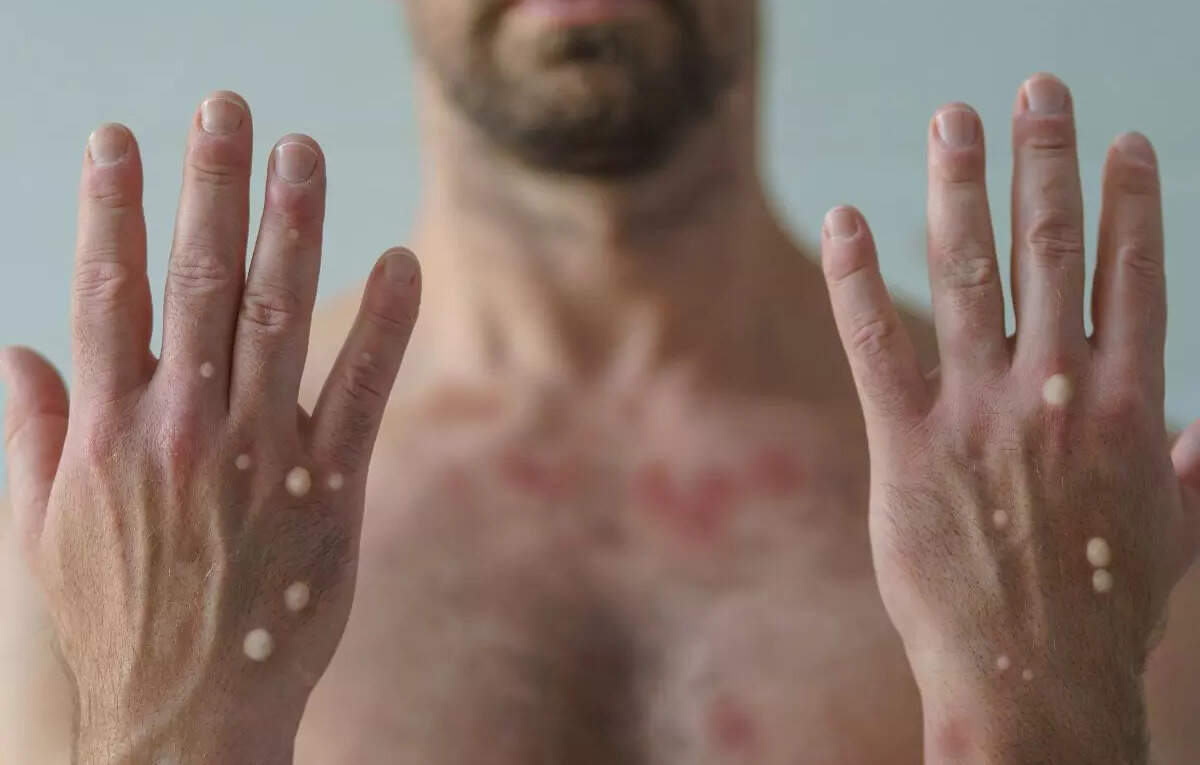 Căn bệnh này từng giết hàng trăm triệu người: Vì sao nhân loại bỗng dưng xóa sổ được chỉ sau vài thập kỷ?- Ảnh 4.