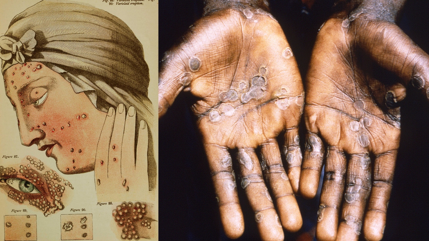 Căn bệnh này từng giết hàng trăm triệu người: Vì sao nhân loại bỗng dưng xóa sổ được chỉ sau vài thập kỷ?- Ảnh 1.