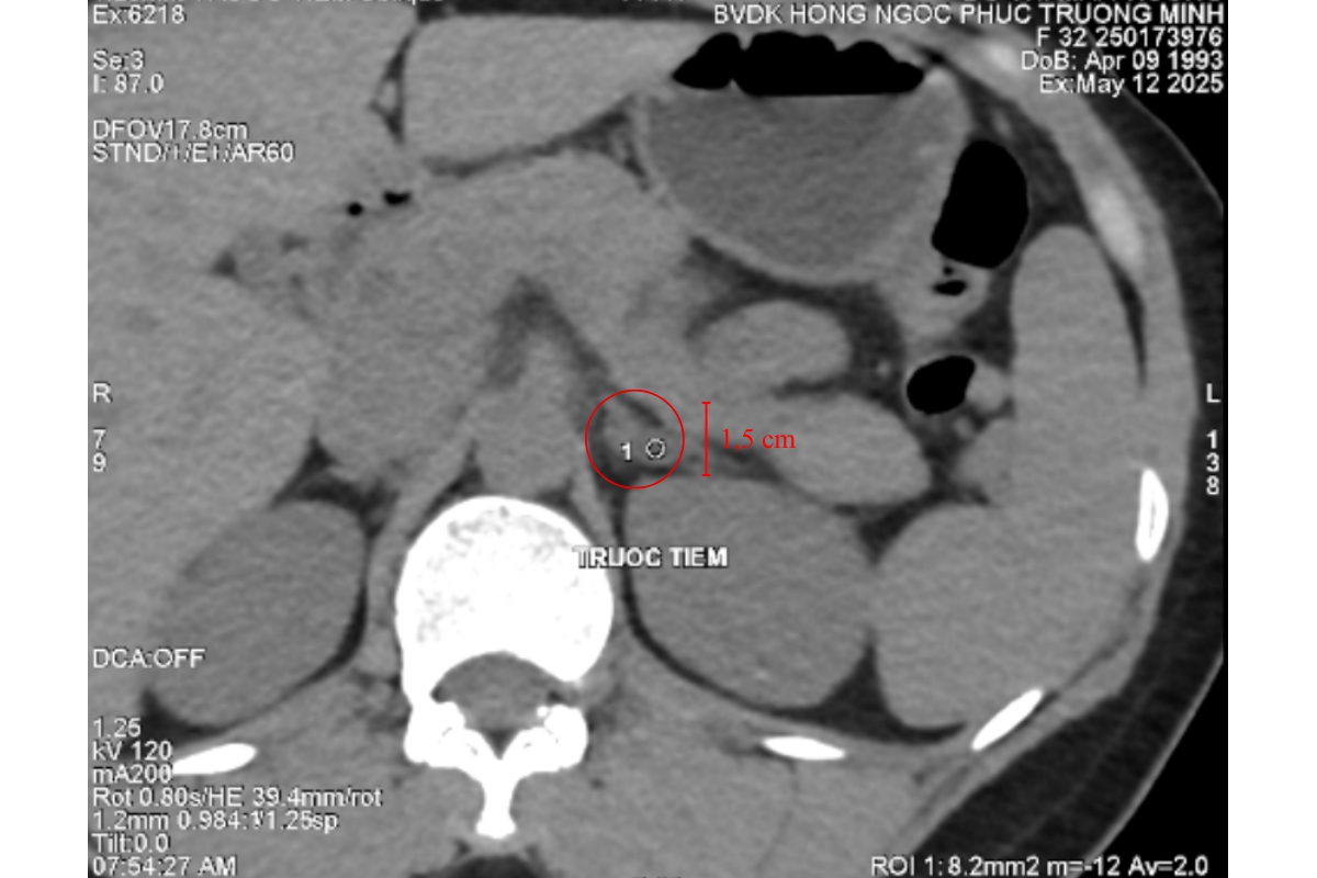 Cô gái trẻ thường xuyên tăng huyết áp không ngờ mắc u tuyến thượng thận - Ảnh 1.