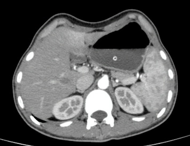 Tình trạng Hẹp môn vị X quang dạ dày.