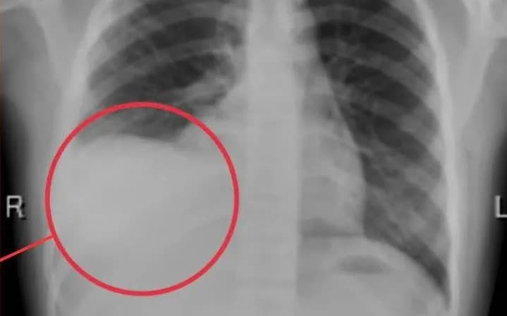 Cảnh báo tràn dịch màng phổi ở trẻ: Nguy hiểm nếu chậm phát hiện- Ảnh 1.