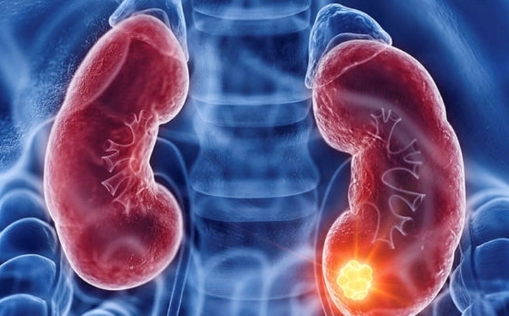 Ung thư thận có chữa khỏi?- Ảnh 1.