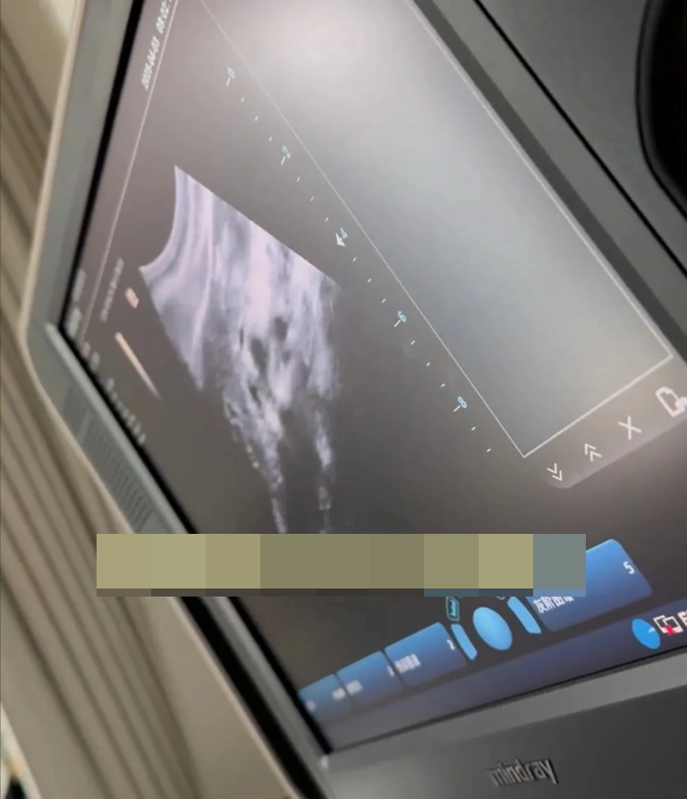 Một nữ diễn viên hạng A phải cắt bỏ túi mật vì sỏi mật, túi mật mất chức năng- Ảnh 2.