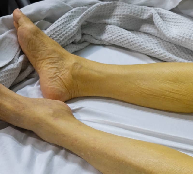 Soi làn da ra ngay bệnh gan: Thấy 3 kiểu “đỏ, đen, vàng” này đi khám nhanh còn kịp!- Ảnh 2.