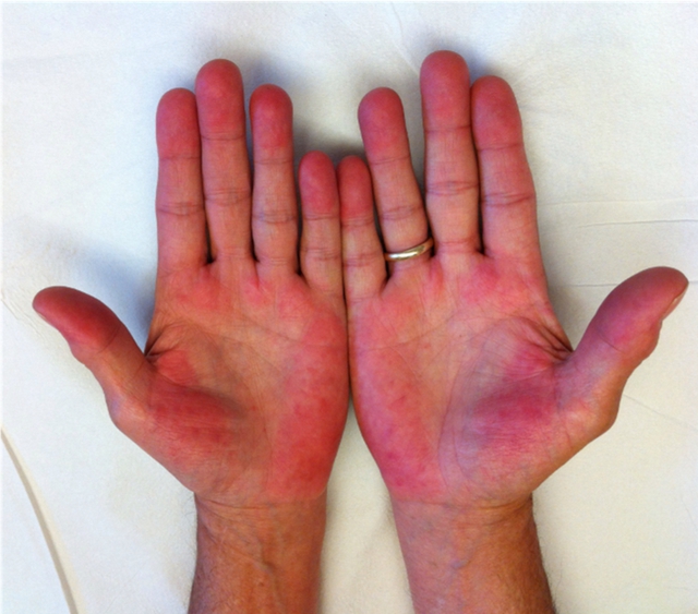 Soi làn da ra ngay bệnh gan: Thấy 3 kiểu “đỏ, đen, vàng” này đi khám nhanh còn kịp!- Ảnh 1.