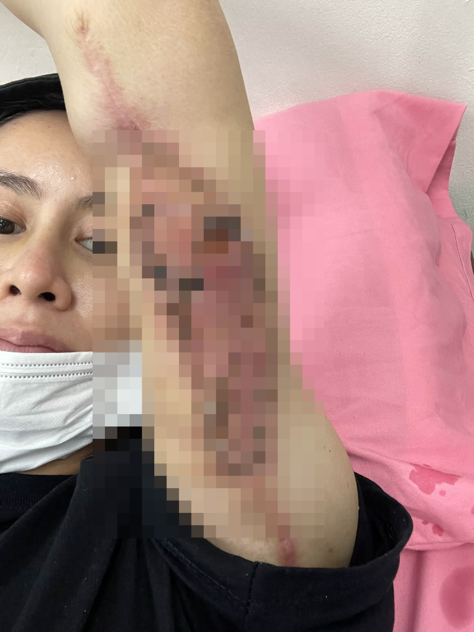 Netizen Việt sốc vì người phụ nữ có tay biến dạng sau hút mỡ, sự thật là gì?- Ảnh 4. Netizen Việt sốc vì người phụ nữ có tay biến dạng sau hút mỡ, sự thật là gì?- Ảnh 4.