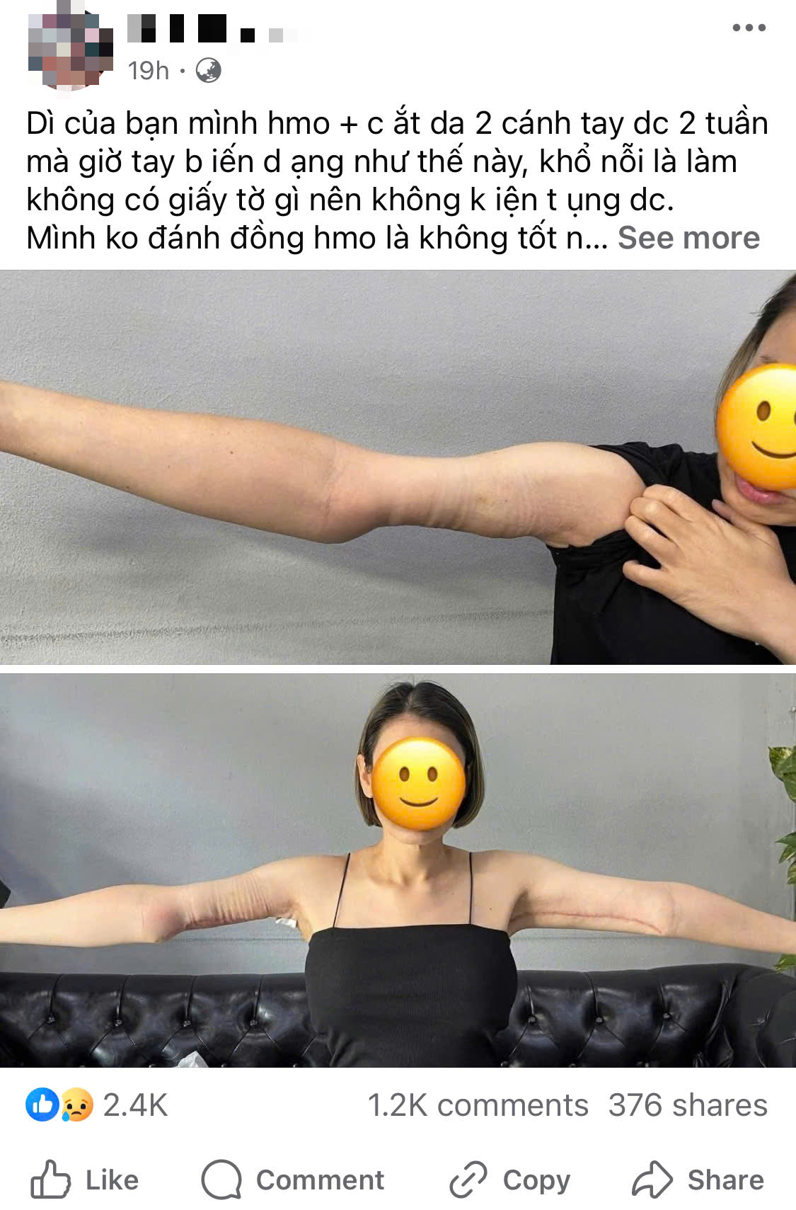 Netizen Việt sốc vì người phụ nữ có tay biến dạng sau hút mỡ, sự thật là gì?- Ảnh 1. Netizen Việt sốc vì người phụ nữ có tay biến dạng sau hút mỡ, sự thật là gì?- Ảnh 1.