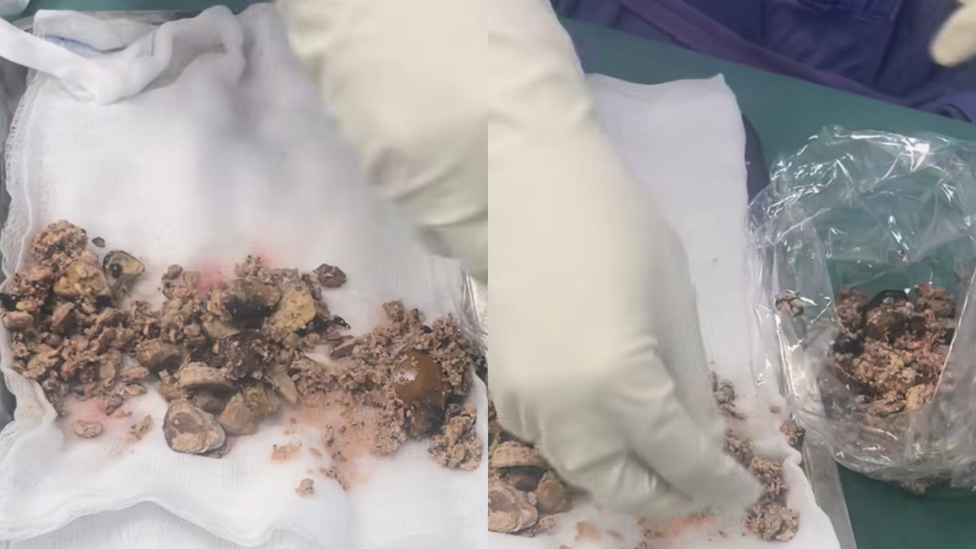 Thấy thứ được lấy ra từ 2 quả thận của bệnh nhân, bác sĩ thốt lên: ‘Sức chịu đựng quá phi thường’- Ảnh 1.